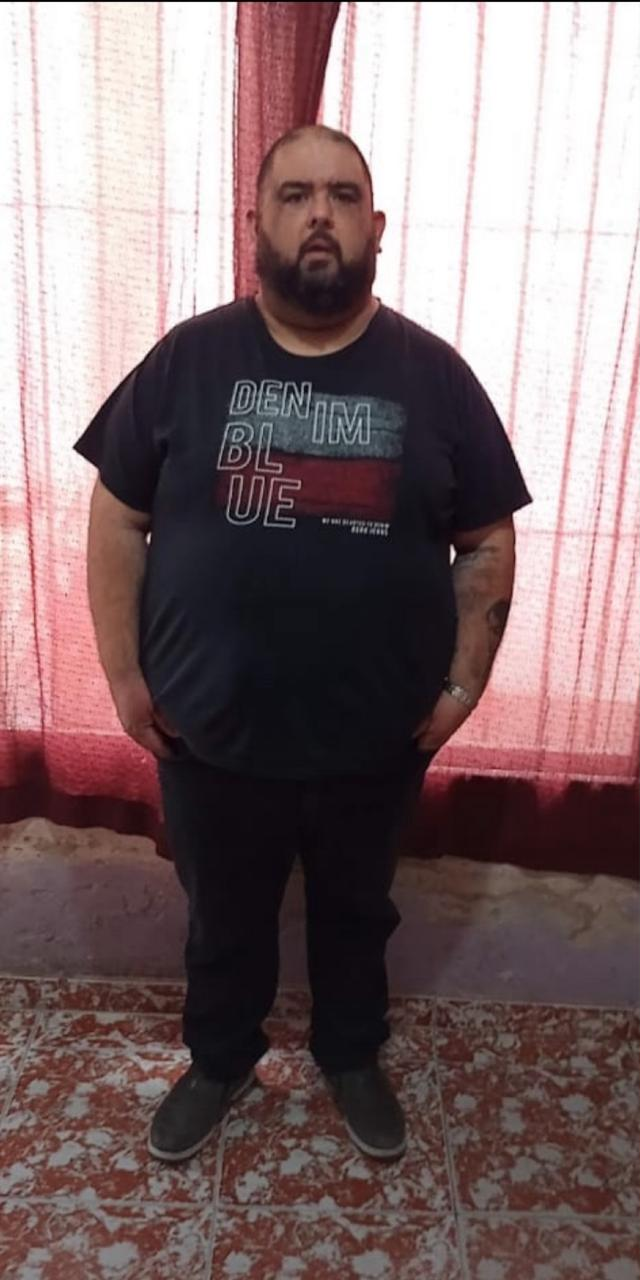 Paciente antes del tratamiento de cirugía bariátrica